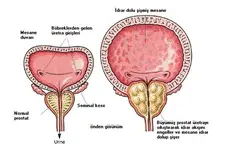 Benign Prostat Hiperplazisi Belirtileri ve Tedavisi