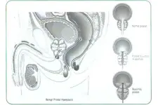 Erkeklerde Prostat Belirtileri ve Tedavisi