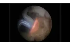 Kapalı Prostat Ameliyatı Riskleri ve Sonrası