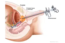 Prostat İltihabı Belirtileri ve Tedavisi