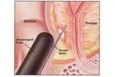 Prostat Masajı Nasıl Yapılır?