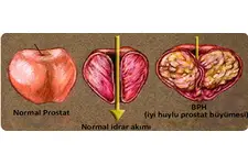 Prostat Sıvısı Özellikleri ve Faydaları Nelerdir?